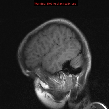 File:Neurofibromatosis type 1 with optic nerve glioma (Radiopaedia 16288-15965 Sagittal T1 4).jpg