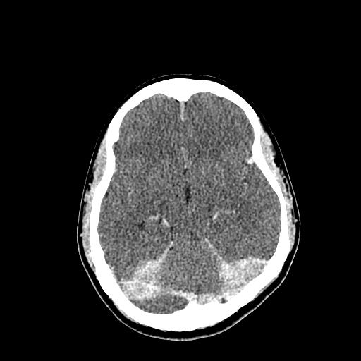 File:Neurofibromatosis type 2 (Radiopaedia 25389-25637 Axial C+ 41).jpg