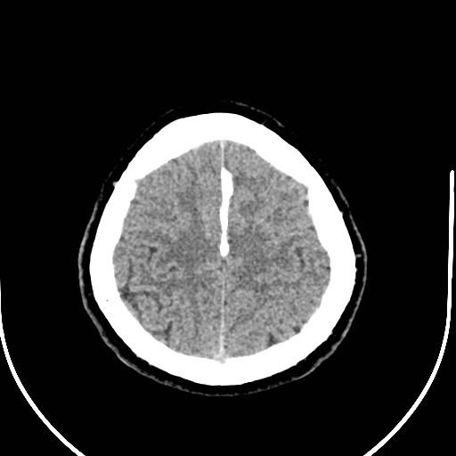 Neurofibromatosis type 2 (Radiopaedia 79097-92047 Axial non-contrast 51).jpg