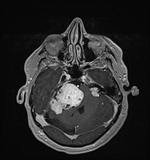 Neurofibromatosis type 2 (Radiopaedia 79097-92049 Axial T1 C+ 62).jpg