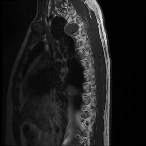 File:Neurofibromatosis type 2 (spinal manifestations) (Radiopaedia 53943-60070 D 13).png