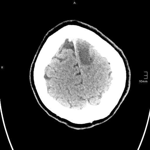 File:Neurotoxoplasmosis - concentric target sign (Radiopaedia 70644-80783 Axial non-contrast 34).jpg