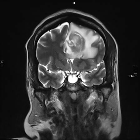 File:Neurotoxoplasmosis - concentric target sign (Radiopaedia 70644-80784 Coronal T2 28).jpg