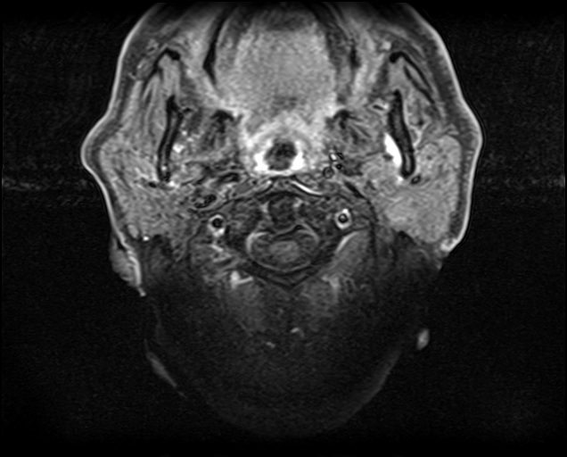 File:Non-Hodgkin lymphoma - parotid gland (Radiopaedia 71531-81890 Axial T1 C+ fat sat 15).jpg