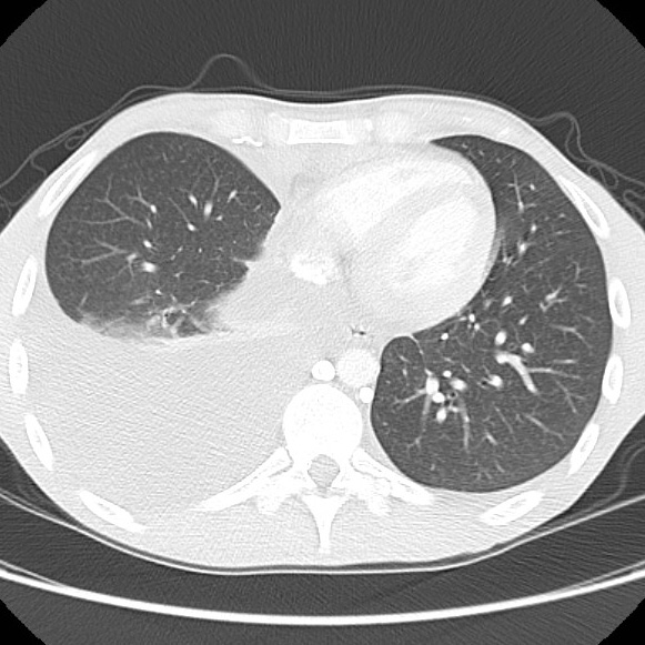 File:Non-Hodgkin lymphoma involving lung (Radiopaedia 29094-29470 Axial lung window 48).jpg