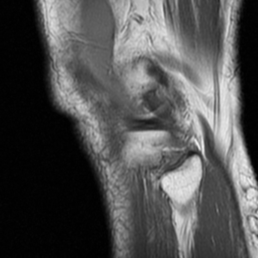 File:Non-displaced patella fracture (Radiopaedia 15932-15582 Sagittal T1 18).jpg