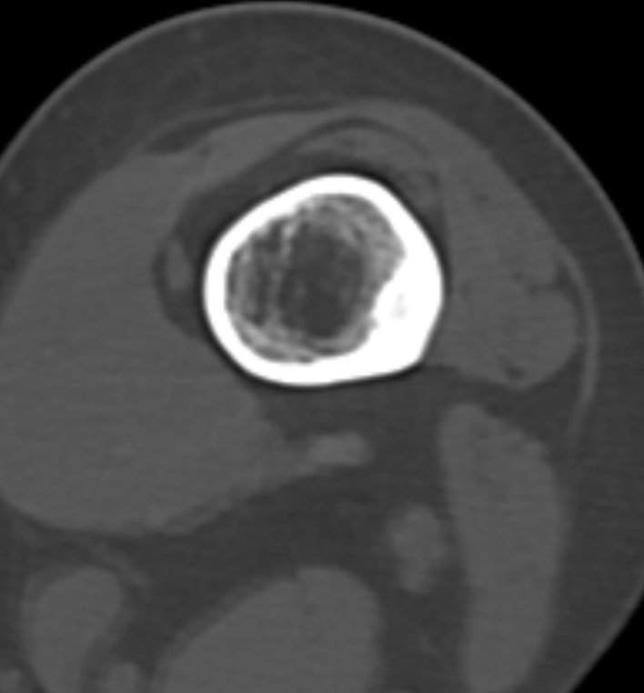 Non-ossifying fibroma - femur (Radiopaedia 82786-97042 Axial bone window 38).jpg