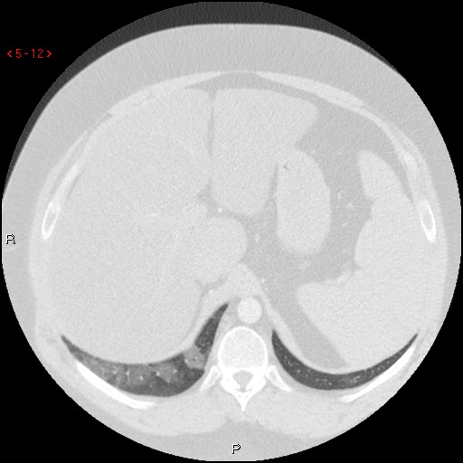 File:Non-specific interstitial pneumonitis (Radiopaedia 27044-27222 Axial lung window 3).jpg