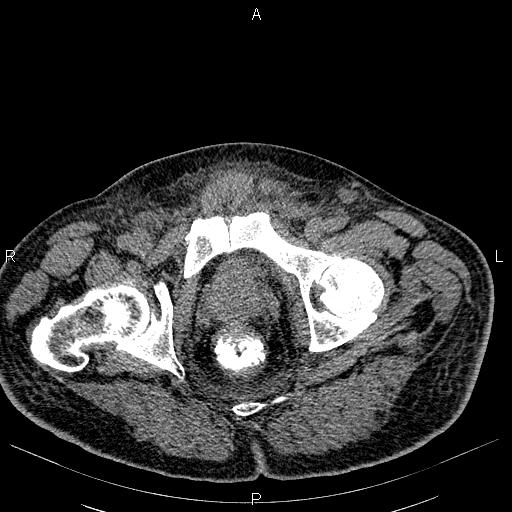 File:Non Hodgkin lymphoma in a patient with ankylosing spondylitis (Radiopaedia 84323-99621 Axial non-contrast 60).jpg