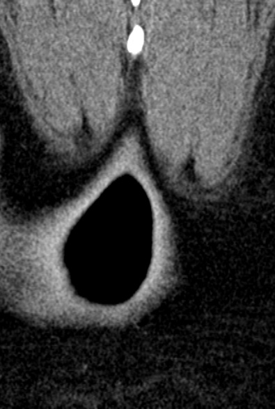 Normal CT lumbar spine (Radiopaedia 53981-60118 F 110).jpg