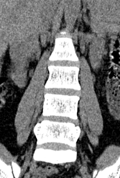Normal CT lumbar spine (Radiopaedia 53981-60118 F 28).jpg