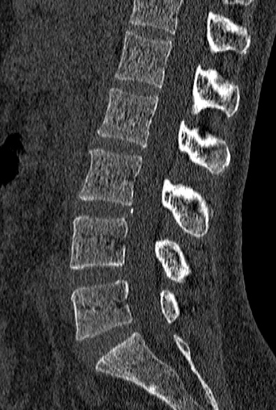 File:Normal CT lumbar spine (Radiopaedia 53981-60118 Sagittal bone window 48).jpg