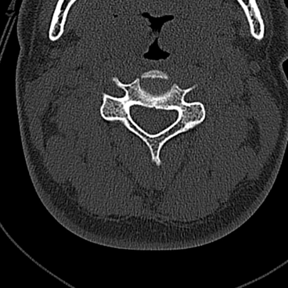 File:Normal CT of the cervical spine (Radiopaedia 53322-59305 Axial bone window 104).jpg