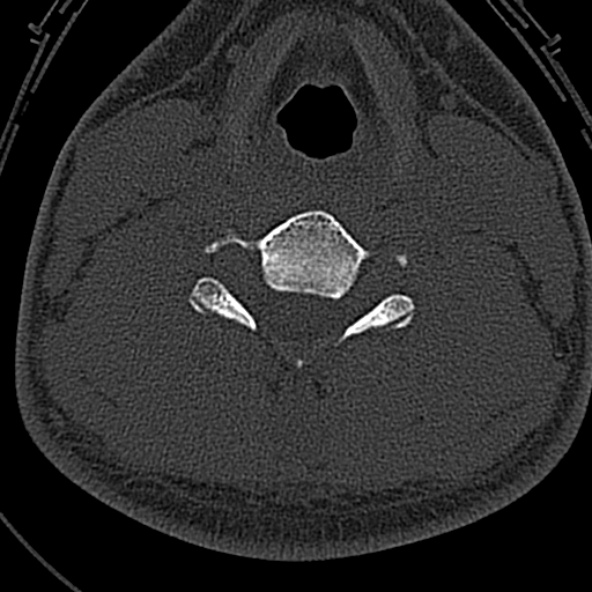 File:Normal CT of the cervical spine (Radiopaedia 53322-59305 Axial bone window 165).jpg