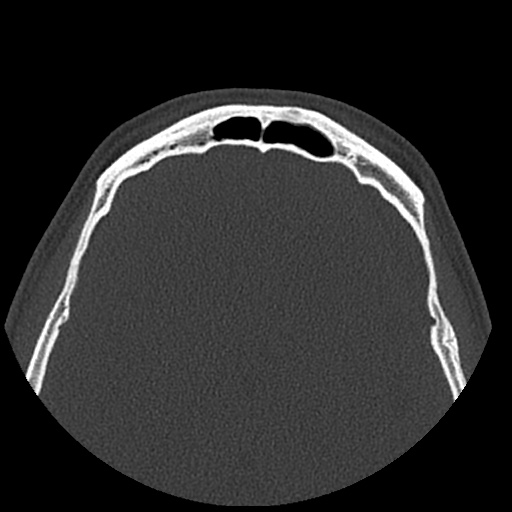Normal CT paranasal sinuses (Radiopaedia 42286-45390 Axial bone window 21).jpg