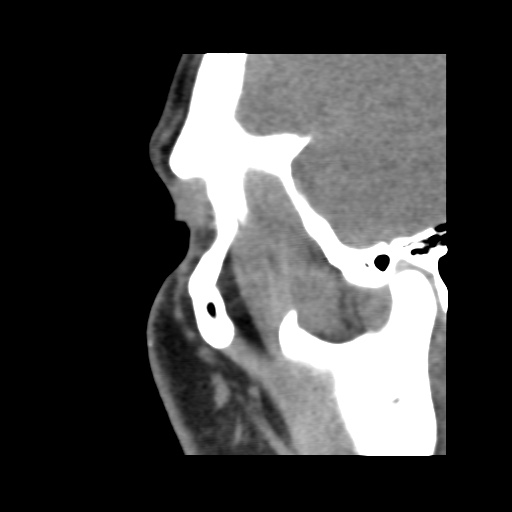 Normal CT paranasal sinuses (Radiopaedia 42286-45390 F 123).jpg
