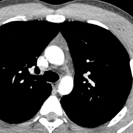 File:Normal CT pulmonary veins (pre RF ablation) (Radiopaedia 41748-44702 A 26).png