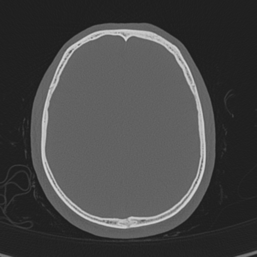 Normal CT skull (Radiopaedia 40798-43459 A 107).png