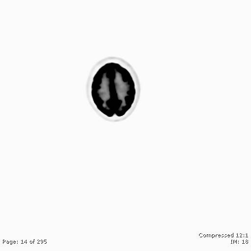 File:Normal F-18 FDG PET-CT (Radiopaedia 77382-89510 C 14).jpg