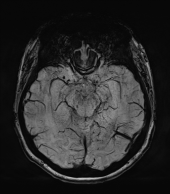 Normal MRI internal auditory canal (Radiopaedia 41613-44525 Axial SWI MIP 32).png