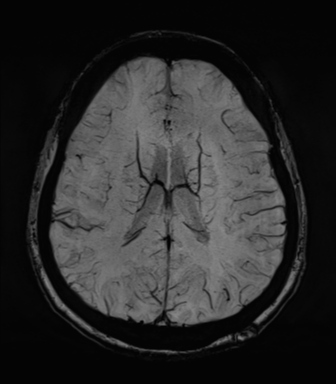 Normal MRI internal auditory canal (Radiopaedia 41613-44525 Axial SWI MIP 50).png