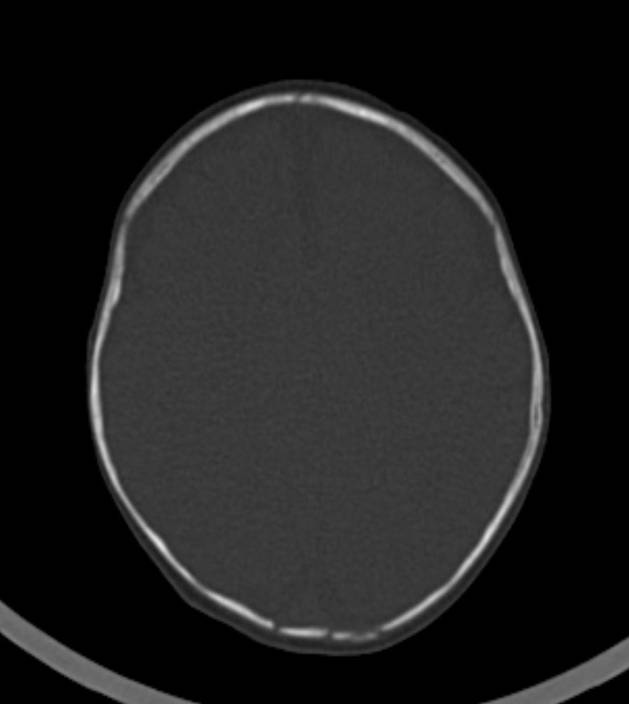 Normal brain CT - 2-month-old (Radiopaedia 53369-59350 Axial bone window 19).jpg