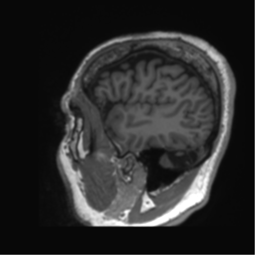 Normal brain MRI (non-focal epilepsy protocol) (Radiopaedia 53917-60040 Sagittal T1 7).png
