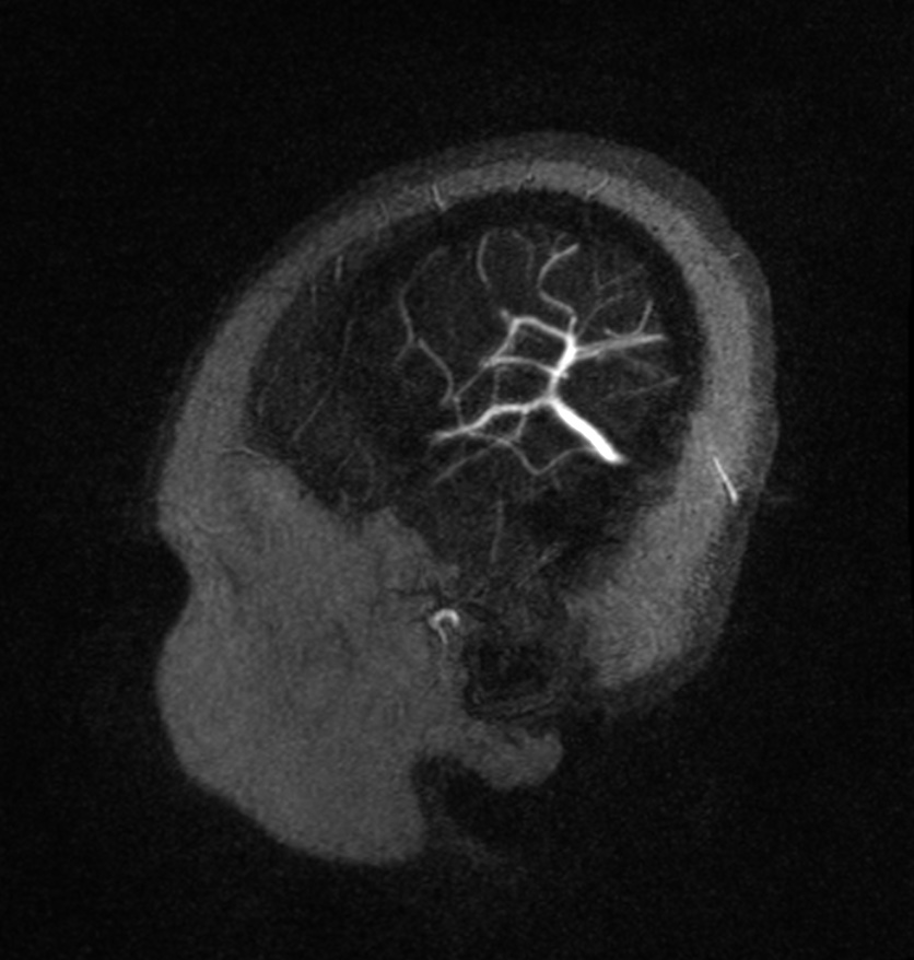 Normal brain MRI and venogram (Radiopaedia 39554-41862 Sagittal MRV 3).jpg
