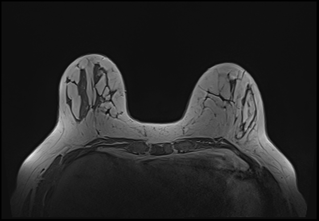 File:Normal breast MRI - dense breasts (Radiopaedia 80454-93850 Axial T1 67).jpg