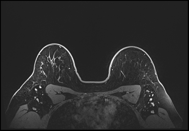 Normal breast MRI - dense breasts (Radiopaedia 80454-93850 C 179).jpg