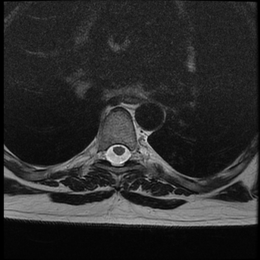 File:Normal cervical and thoracic spine MRI (Radiopaedia 35630-37156 H 28).png