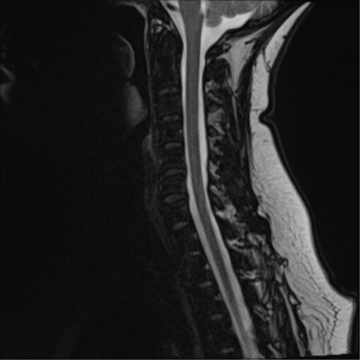 File:Normal cervical spine MRI (including Dixon) (Radiopaedia 42762-45925 Dixon- opposed phase 8).png