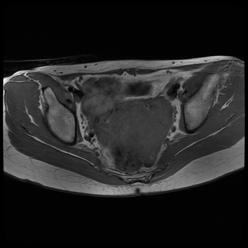 File:Normal female pelvis MRI (retroverted uterus) (Radiopaedia 61832-69933 Axial T1 17).jpg