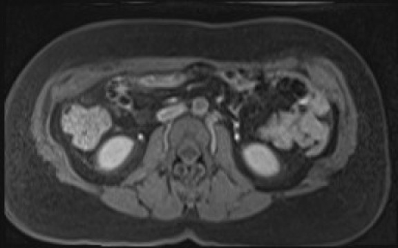 File:Normal hepatobiliary phase liver MRI (Radiopaedia 58968-66230 A 77).jpg