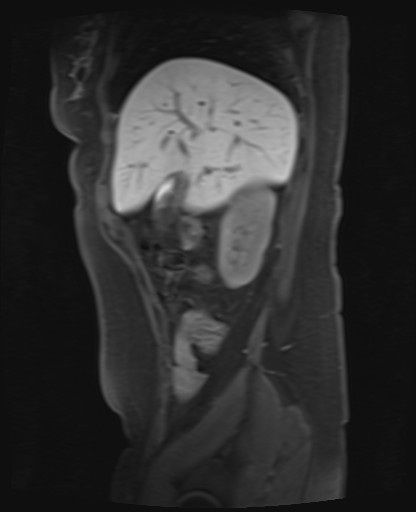 File:Normal hepatobiliary phase liver MRI (Radiopaedia 58968-66230 C 19).jpg