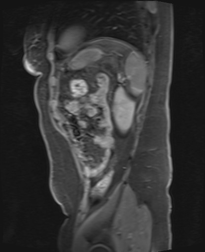 File:Normal hepatobiliary phase liver MRI (Radiopaedia 58968-66230 C 65).jpg