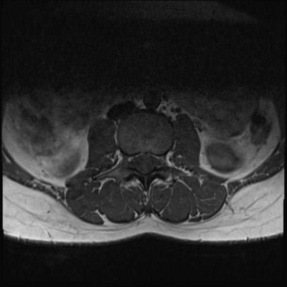 File:Normal lumbar spine MRI- 3 T (Radiopaedia 53280-59250 Axial 5).jpg