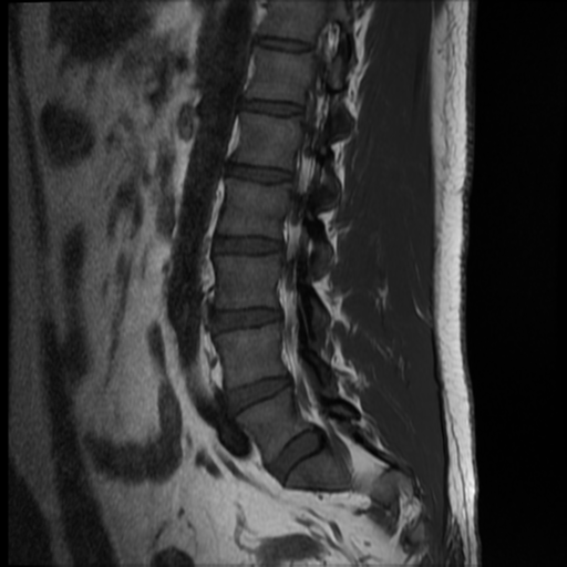 File:Normal lumbar spine MRI (Radiopaedia 35543-37039 Sagittal T1 4).png