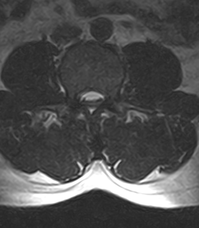 Normal lumbar spine MRI - low-field MRI scanner (Radiopaedia 40976-43699 Axial T2 53).jpg