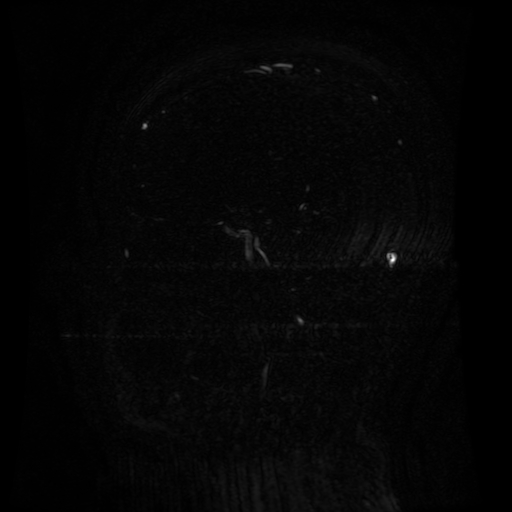 Normal noncontrast MR venography (Radiopaedia 87578-103957 A 101).jpg