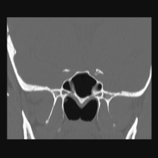 Normal sinus CT (annotated) (Radiopaedia 78917-91810 Coronal bone window 44).jpg