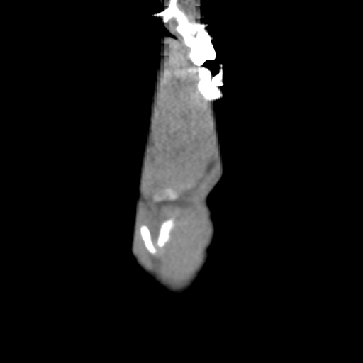 File:Normal trauma cervical spine (Radiopaedia 41017-43760 Coronal non-contrast 3).png