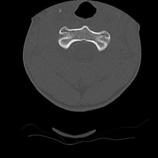 Normal trauma spine imaging (age 16) (Radiopaedia 45335-49358 Axial bone window 19).jpg