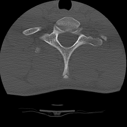 File:Normal trauma spine imaging (age 16) (Radiopaedia 45335-49358 Axial bone window 68).jpg