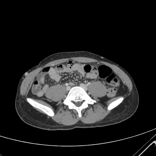 File:Nutmeg liver- Budd-Chiari syndrome (Radiopaedia 46234-50635 B 48).png