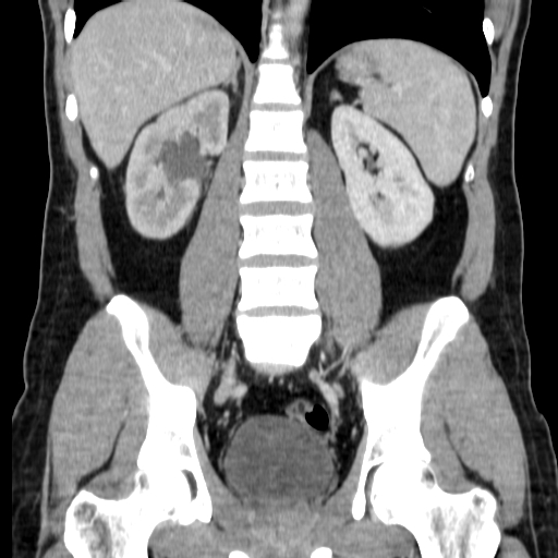 File:Obstructing ureteric calculus (Radiopaedia 18615-18514 C 50).jpg