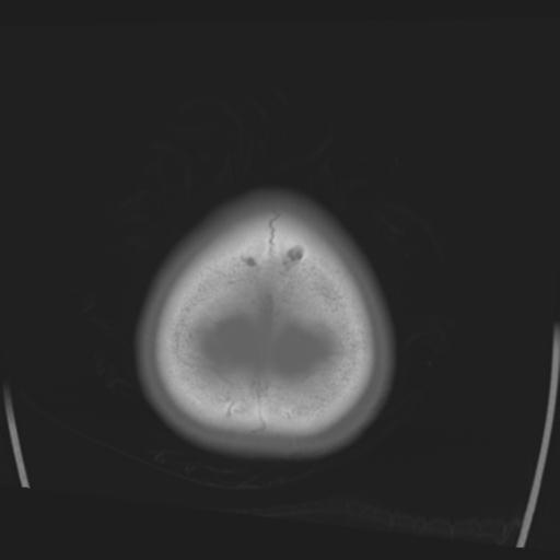 File:Obstructive hydrocephalus (Radiopaedia 30453-31119 Axial bone window 3).jpg