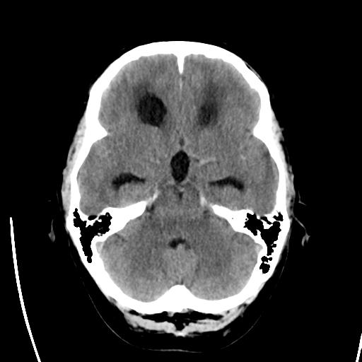 File:Obstructive hydrocephalus (Radiopaedia 30453-31119 Axial non-contrast 8).jpg