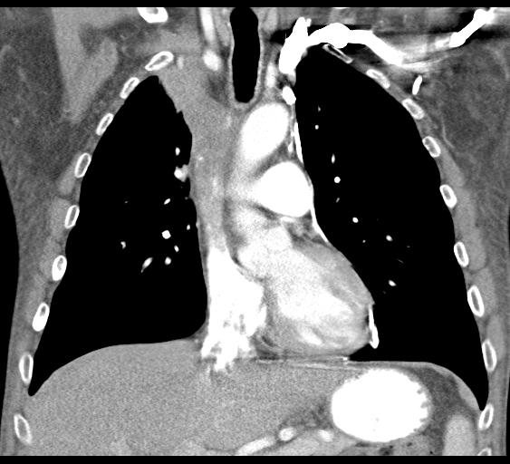 File:Obstructive superior vena cava tumor thrombus (Radiopaedia 28046-28306 B 21).jpg