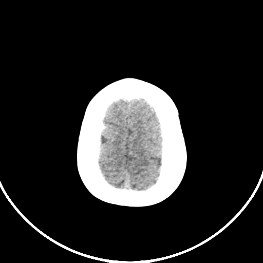 Occipital encephalocele (Radiopaedia 87339-103636 Axial non-contrast 73).jpg